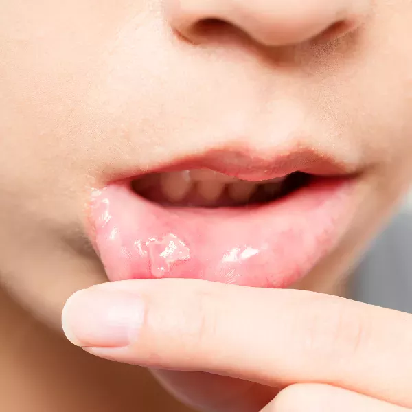 canker and cold sore treatment in north york