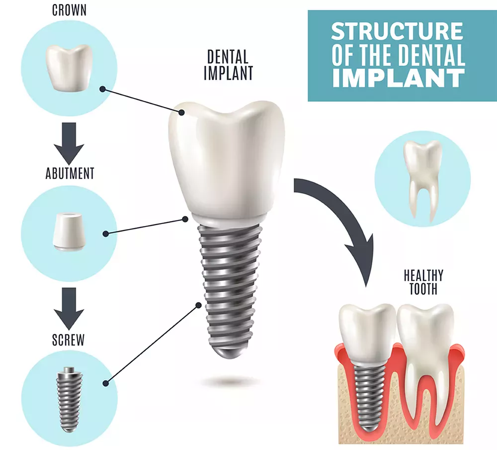 dental implant near you