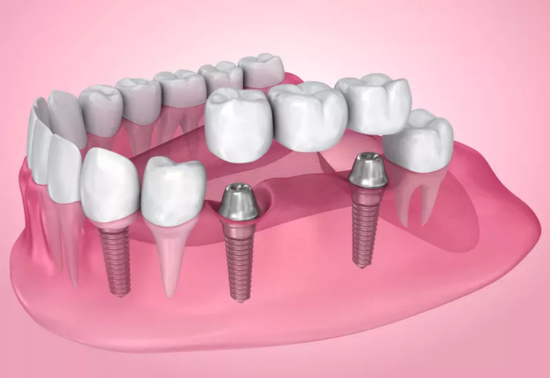 dental implant procedure process at lilac family dentistry