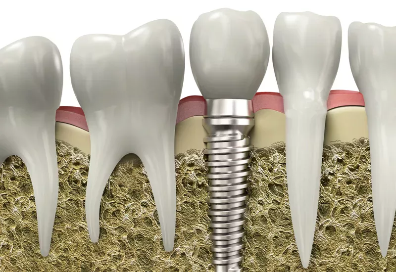 dental implants in north york