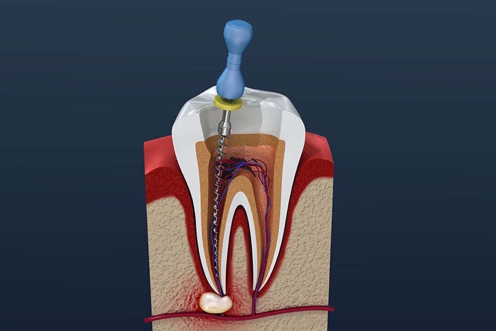 root canal therapy in north york