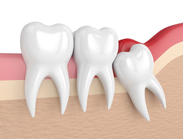 Everything You Need To Know About Wisdom Tooth Extraction